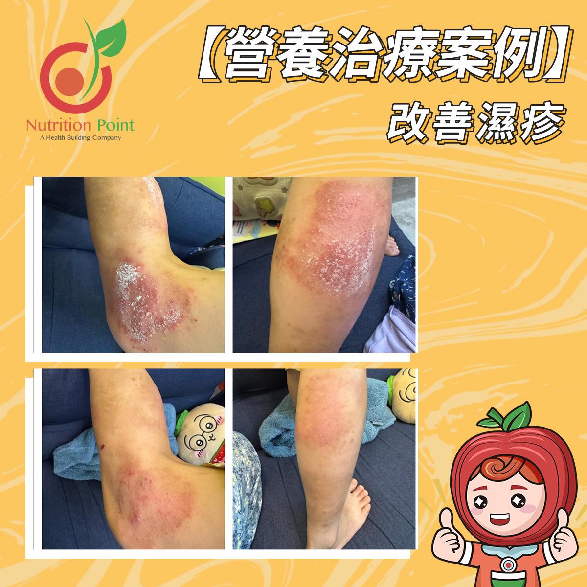 【營養治療案例】濕疹改善