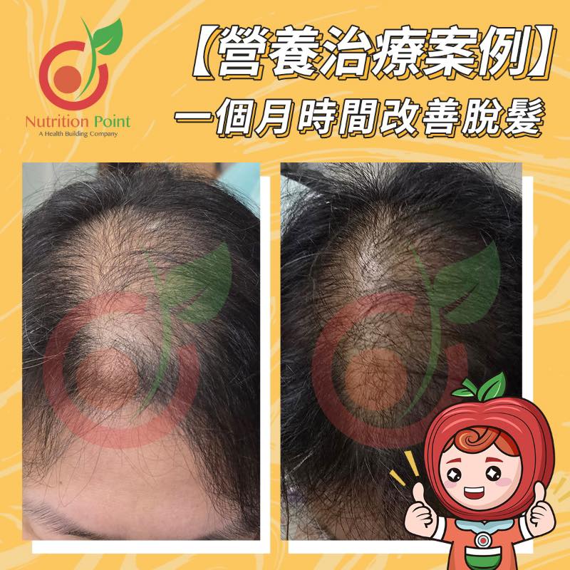 【營養治療案例】改善脫髮