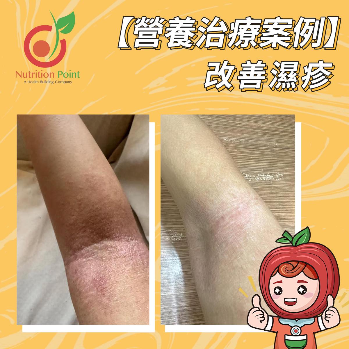 【營養治療案例】濕疹改善