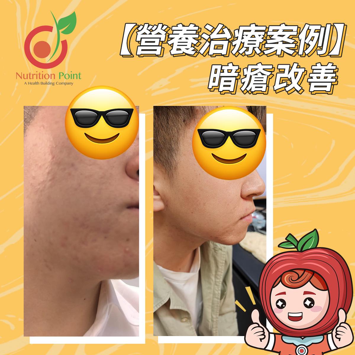 【營養治療案例】暗瘡改善