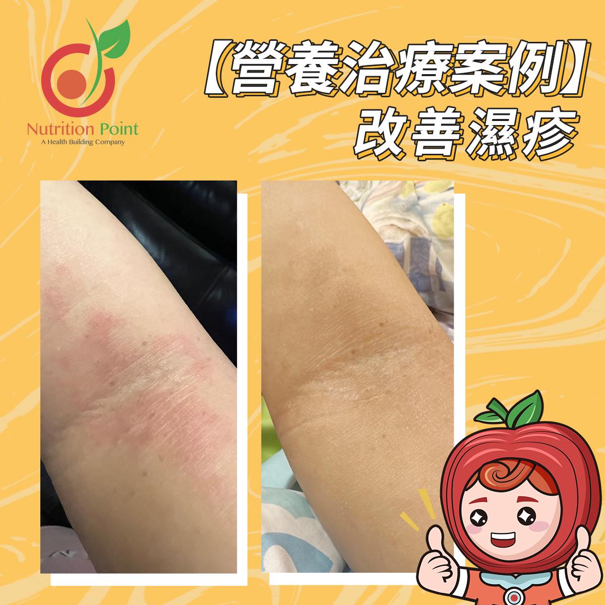 【營養治療案例】改善濕疹