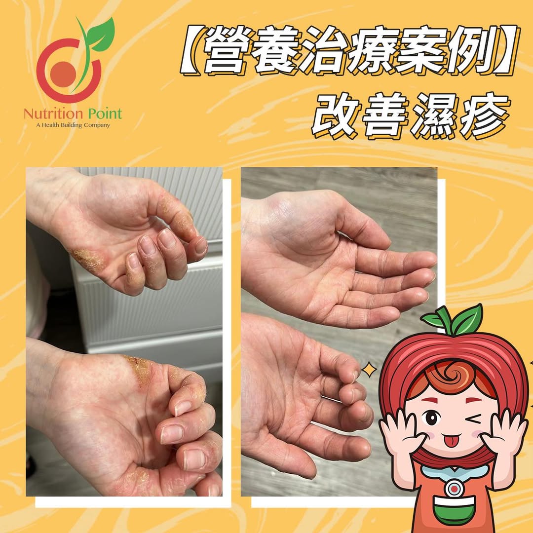 【營養治療案例】 改善濕疹