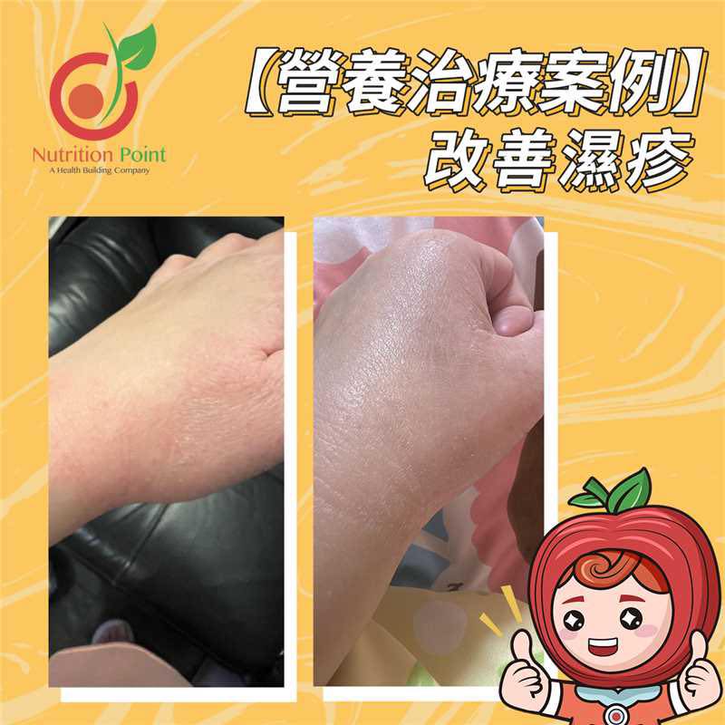 【營養治療案例】濕疹改善